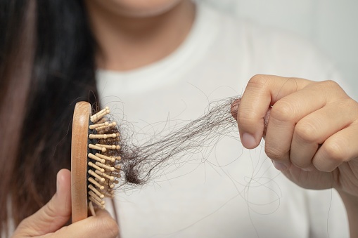 shock loss after a hair transplant