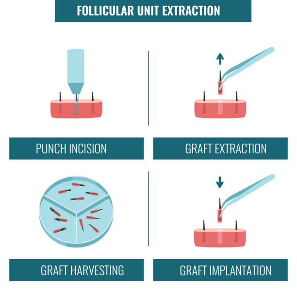 FUE donor area
