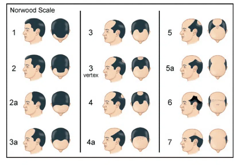 Baldness evolution with the Norwood scale