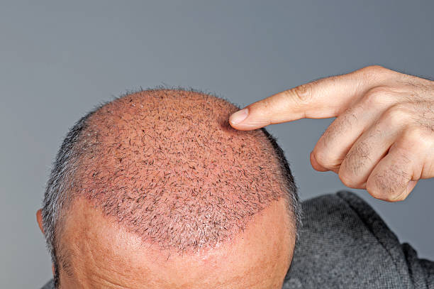 post-hair transplant care