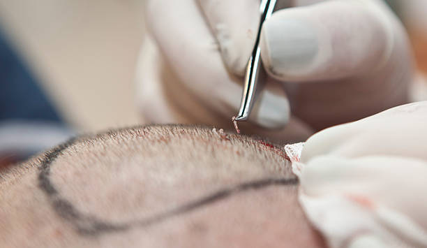 hair transplant