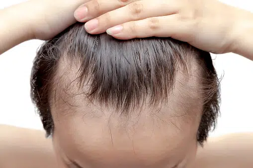Age of 30 and baldness stabilization