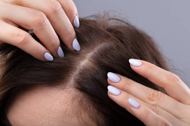 hair thinning