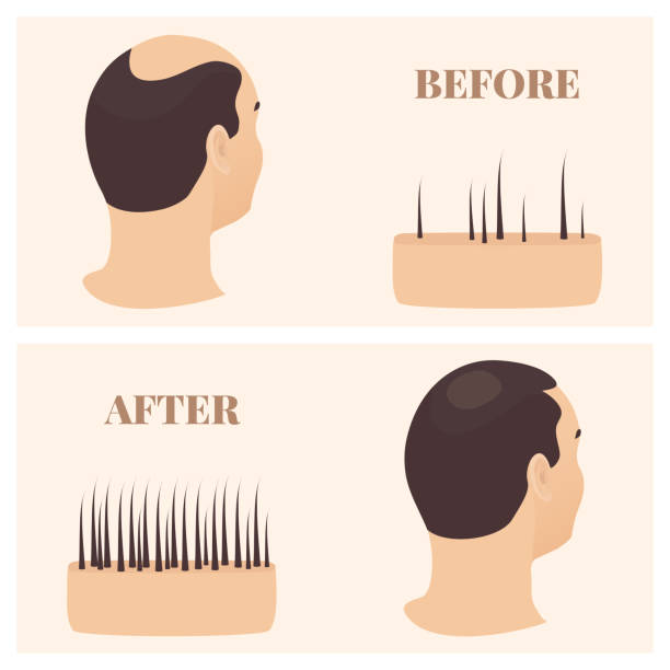 Before and after a hair transplant